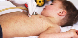 Alarma: creen que la falta de vacunación es fuerte causa de los 21 casos de sarampión en Twin Cities Alarma: creen que la falta de vacunación es fuerte causa de los 21 casos de sarampión en Twin Cities