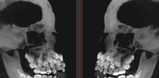 Extraño caso de una niña con 81 dientes desafía a odontólogos Extraño caso de una niña con 81 dientes desafía a odontólogos