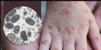 El MDH informa los primeros casos de viruela del mono desde 2022 El MDH informa los primeros casos de viruela del mono desde 2022