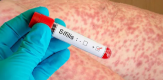Houston: brote de sífilis provoca un aumento del 128 % en los casos entre las mujeres Houston: brote de sífilis provoca un aumento del 128 % en los casos entre las mujeres