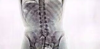 Mujer argentina transportaba 78 cápsulas de cocaína insertadas Mujer argentina transportaba 78 cápsulas de cocaína insertadas