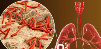 Alerta: el MDH está rastreando un brote de tuberculosis Alerta: el MDH está rastreando un brote de tuberculosis
