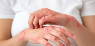 ¿Mito o realidad? El estrés puede detonar herpes zóster ¿Mito o realidad? El estrés puede detonar herpes zóster