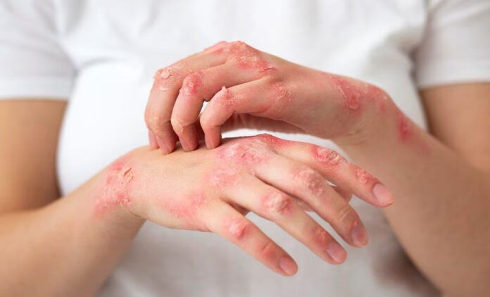 ¿Mito o realidad? El estrés puede detonar herpes zóster
