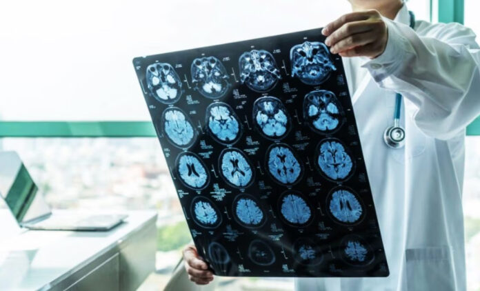 Pacientes que recibieron hormonas de crecimiento contrajeron Alzheimer