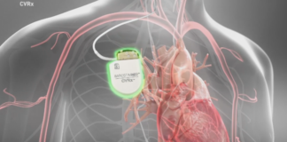 Por primera vez en Minnesota usan dispositivo médico para tratar problemas cardíacos Por primera vez en Minnesota usan dispositivo médico para tratar problemas cardíacos