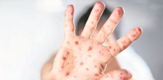 Crece brote de sarampión en refugio para migrantes en Chicago Crece brote de sarampión en refugio para migrantes en Chicago