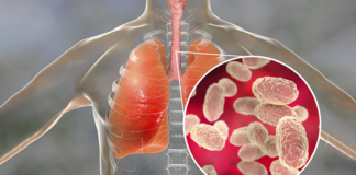 Minnetonka: advierten a familia por múltiples casos de tos ferina Minnetonka: advierten a familia por múltiples casos de tos ferina