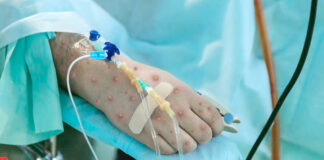 Chile decreta alerta sanitaria preventiva por viruela del mono Chile decreta alerta sanitaria preventiva por viruela del mono