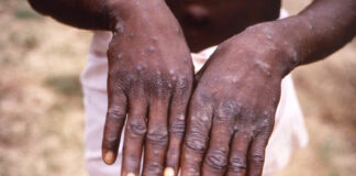 548 muertos y 15 mil casos de mpox en República Democrática del Congo 548 muertos y 15 mil casos de mpox en República Democrática del Congo