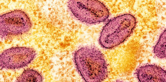 La mpox ya se está propagando en Texas, confirman funcionarios de salud La mpox ya se está propagando en Texas, confirman funcionarios de salud