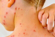 Emiten aviso epidemiológico sarampión en México; aumentan casos en EEUU Emiten aviso epidemiológico sarampión en México; aumentan casos en EEUU