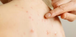 Muere adulto con sarampión en Nuevo México; reportan 200 casos en 9 estados Muere adulto con sarampión en Nuevo México; reportan 200 casos en 9 estados