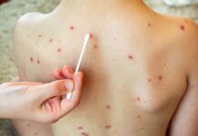 Segundo caso de sarampión de 2025 reportado en Minnesota Segundo caso de sarampión de 2025 reportado en Minnesota