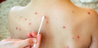 Segundo caso de sarampión de 2025 reportado en Minnesota Segundo caso de sarampión de 2025 reportado en Minnesota