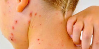 Muere segundo menor en EEUU por causas relacionadas al sarampión Muere segundo menor en EEUU por causas relacionadas al sarampión